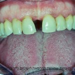 תיקון רווח בשיניים