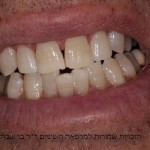 הלבנת שיניים - אחרי