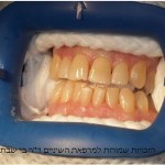 הלבנת שיניים - לפני