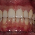 תוצאה סופית שיקום בעזרת כתרי זירקוניה