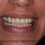 מטופלת חודש לפני חתונתה, עם שחזורים לא אסתטיים בקבוצת שיניים חותכות עליונות, מטעמי תקציב, בוצע שיקום רק ל 4 שיניים קידמיות לא כולל ניבים