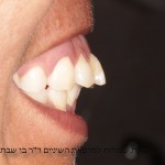 צילום השיניים מצד פרופיל ימין
