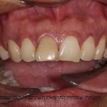 עובדת זרה עם שן חותכת קידמית בגוון צהוב ובהטייה שפתית מודגשת