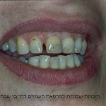 מטופלת בת 35 עם שחזורים לא אסתטיים בשיניים חותכות עליונות, ורווחים לא אסתטיים